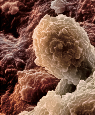 Células de cáncer